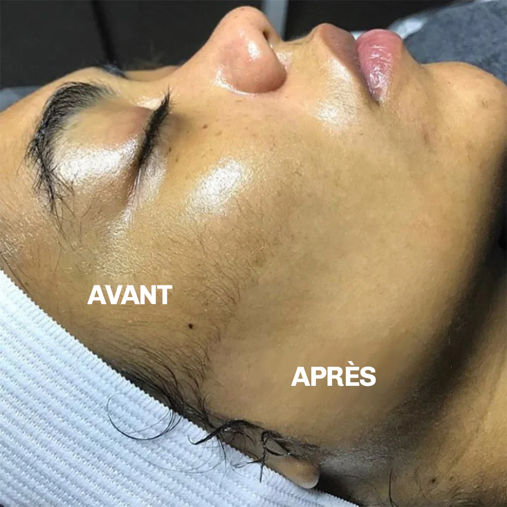 SILKYFLASH+ Dermaplaning Sonique Visage - Image 8